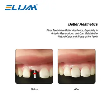 Dental Fiber Pile Fiber Pile 20 stolpar + 4 borrar Dentalprodukter Fiberstolpeborr Skruvgänga Kvarts Blandade storlekar Kit Easyinsmile 8 best sales Dental fibre post - №4