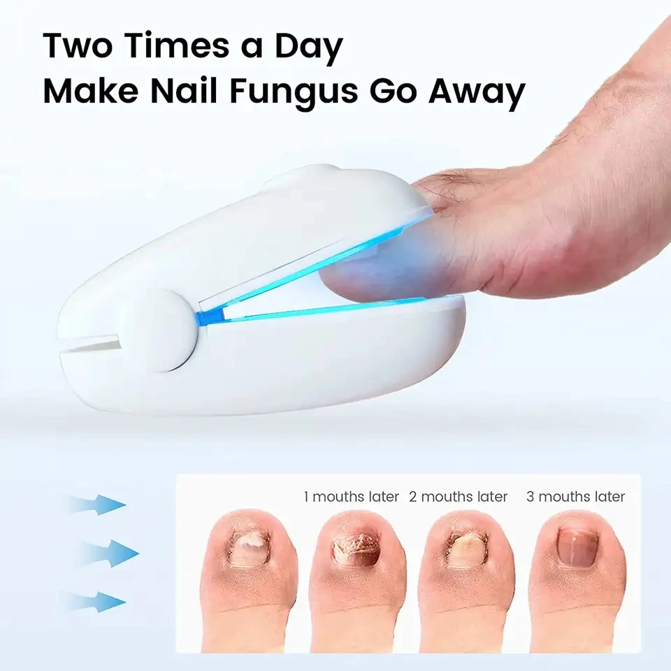 905NM Painless Nail Fungal Treatment Device Laser Hand and Foot Care Whitening Nail Fungal Infection Treatment Device Gray Nail