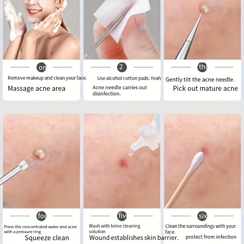 Kit de eliminación de espinillas de 8 piezas, adecuado para eliminar puntos negros, puntos blancos, acné, Kit profesional para apretar acné con caja