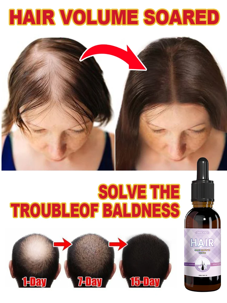 Hot selling product,Rapid hair growth products that can effectively repair baldness and hair loss in 2024