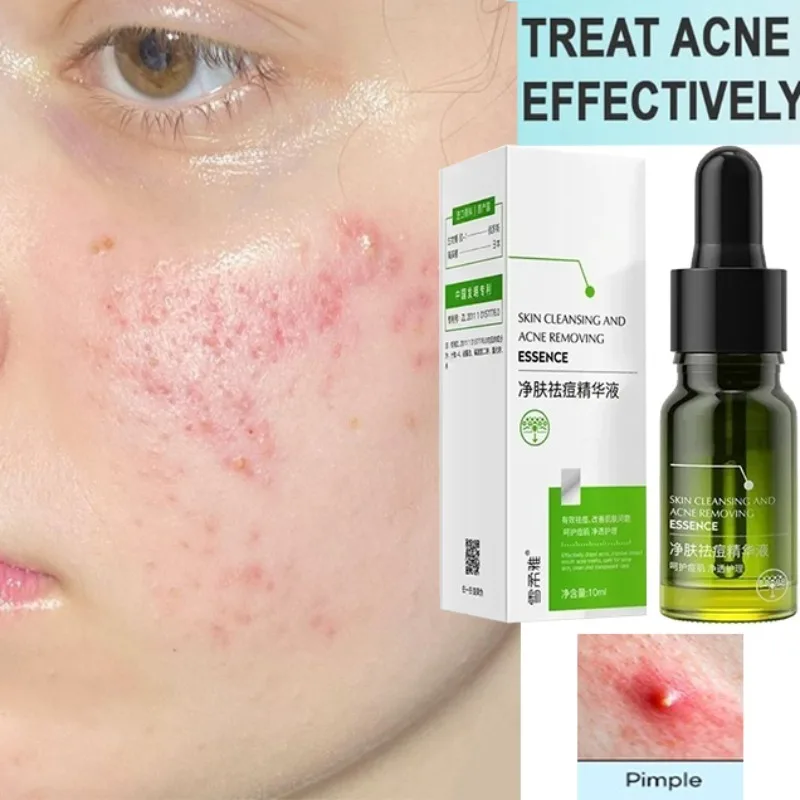 

Moisturizing Acne Remover Serum with Repairing Function for Shrink Pores and Oil Control Skin Care Essential