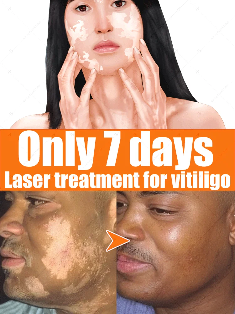 Nieuwe laser-vitiligo-verwijderingsonderzoek in 2025, Blue laser care vitiligo