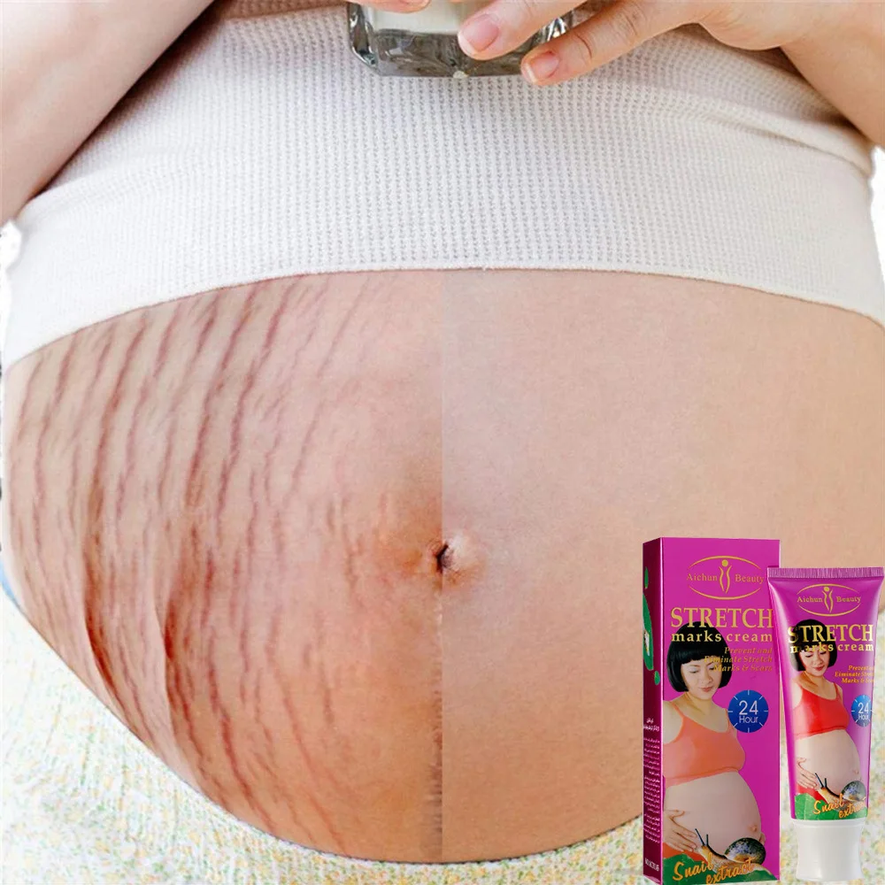 120G Snail Body Milk Desalinates Watermelon Pattern STRETCH marks cream Prevention of stretch marks