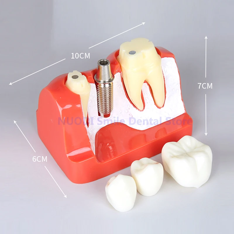 4 Times Dental Implant Teeth Model Analysis  Analysis Crown Bridge Removable Model Dentist Student Practice Studying Tooth Model