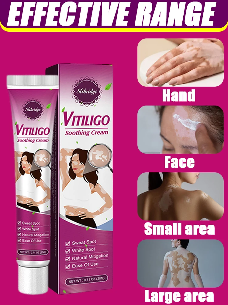 Vitiligo Treatment Cream Melanin Growth Ointment Fast Remove White Spot