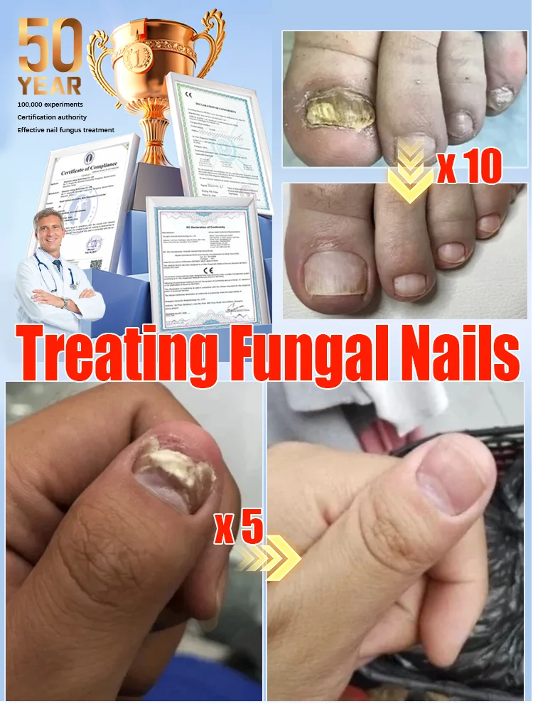 The most powerful black technology in 2025,ᵉᶠᶠᵉᶜᵗⁱᵛᵉ ⁿᵃⁱˡ ᶠᵘⁿᵍᵘˢ ᵗʳᵉᵃᵗᵐᵉⁿᵗ⸴ ʳᵉˢᵗᵒʳᵉ ⁿᵃⁱˡ ʰᵉᵃˡᵗʰ ⁱⁿ ⁷ ᵈᵃʸˢ