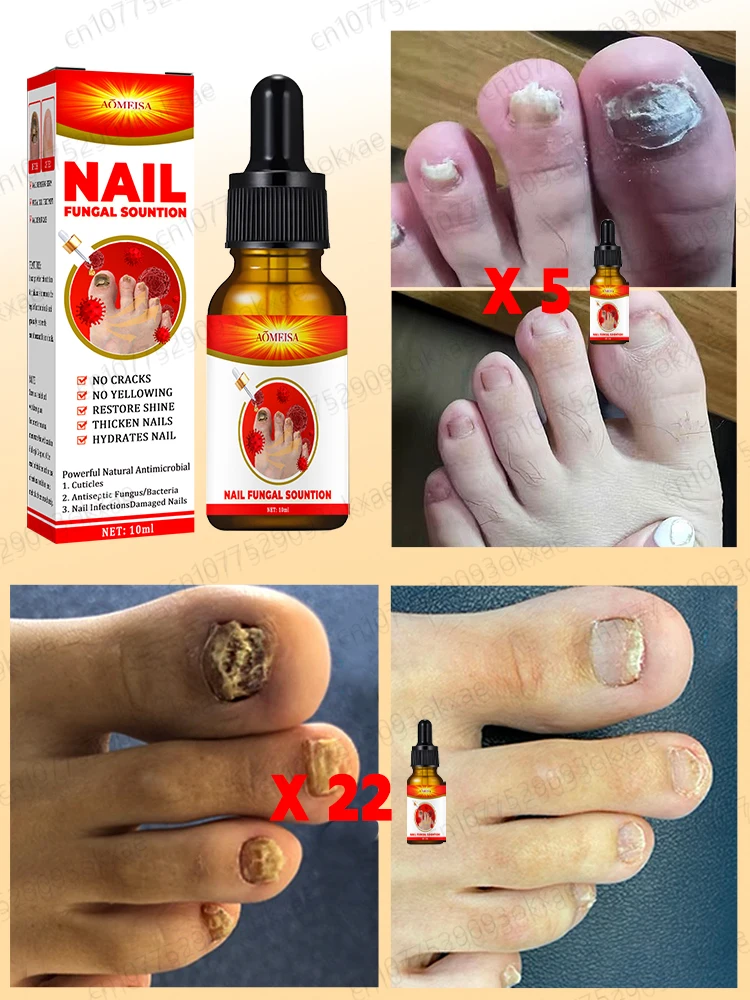 Fungal Nail