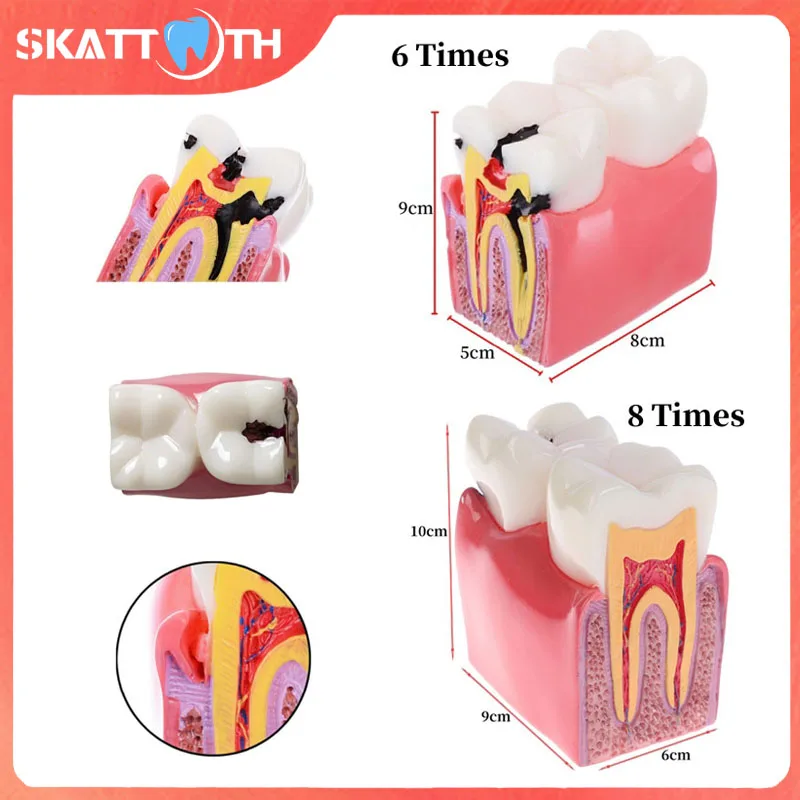 

Dental Teeth Model 6/8 Times Caries Comparsion Study Denture Model Dentistry Anatomy Teaching Model Dentist Demonstration Model
