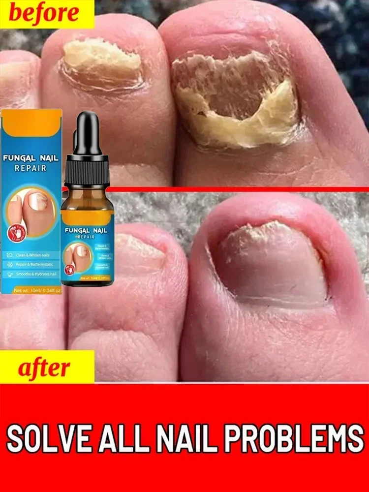 

Nail Fungus Treatment Nail Antifungal Nail Repair Stop Fungal Growth Fingernail Toenail Discolored Nails