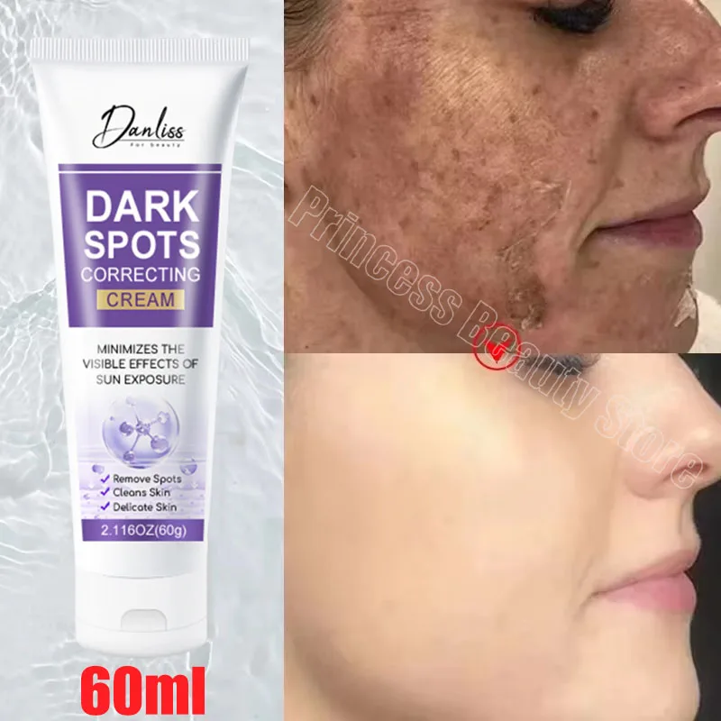 

Whitening Freckle Cream Remove Dark Spots Anti Freckle Face Creams Niacinamide Fade Pigmentation Melasma Brighten Skin Care 60g