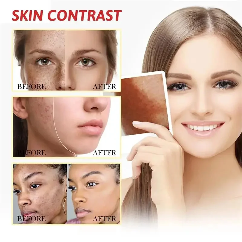 Crema iluminadora de niacinamida, Melasma, Reduce la melanina, aclara la piel oscura, suero Chloasma, desvanece las líneas finas, productos para el cuidado facial coreano