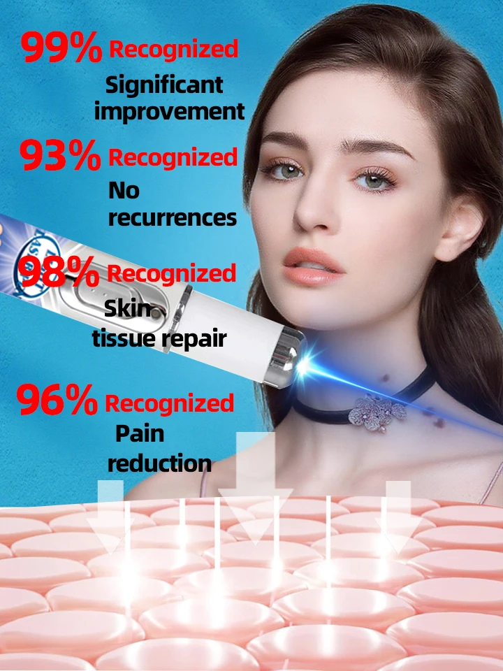 Stylo à lumière bleue pour résoudre les verrues corporelles, outils de soins des verrues