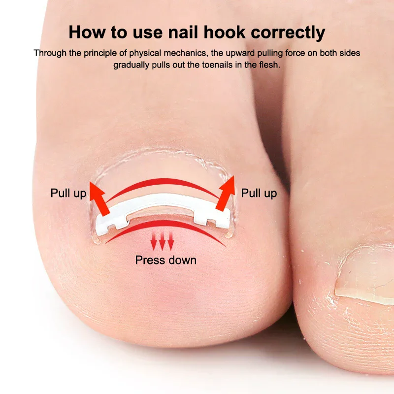 Corrector de uñas encarnadas, herramientas para pedicura, recuperación integrada, tratamiento profesional de uñas encarnadas, cuidado de los pies, 1 Uds.