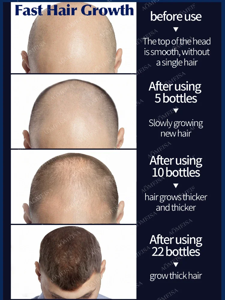 It only takes 7 days to repair baldness. Hair growth essential oil can effectively repair baldness.