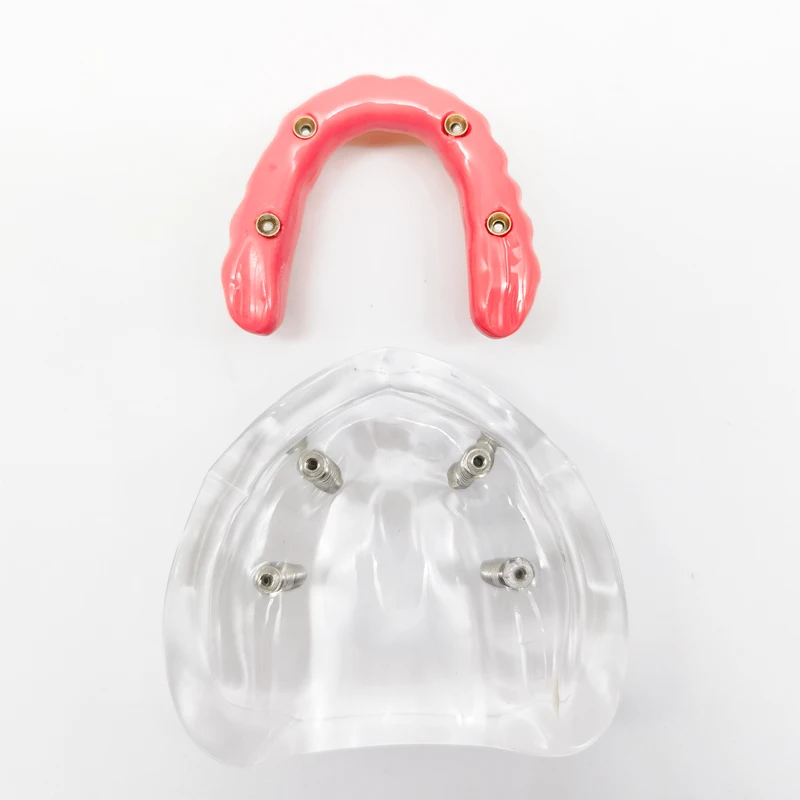 Dental Implant Model Upper/Lower Dental Removable Implant Model with 4 Implants Screws Dental Teaching Demo Model