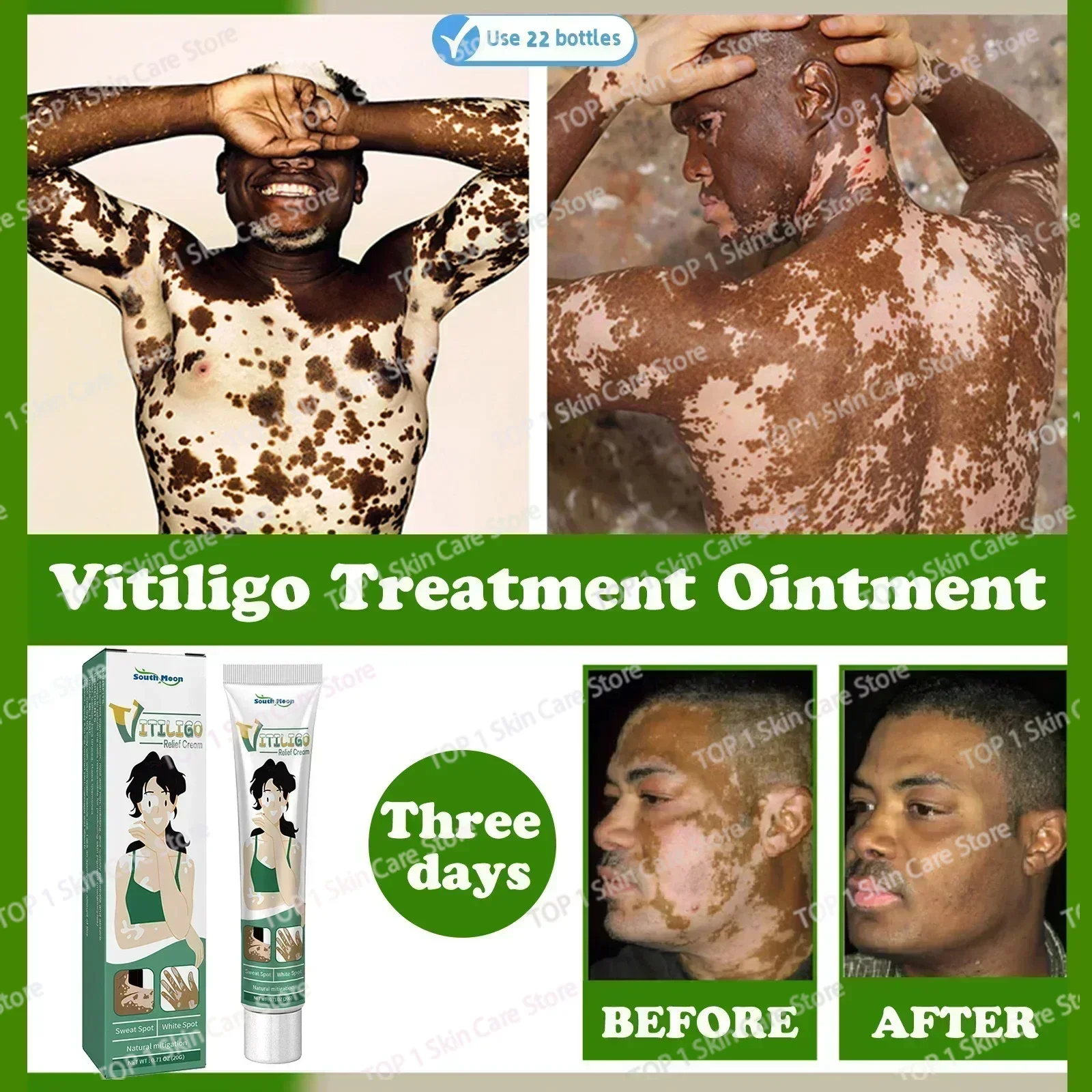 สารสกัดจากสมุนไพร Vitiligo Ointment ลบกลากสีขาว Spot Removal ผิว Vitiligo กําจัด Vitiligo Treatment 0903