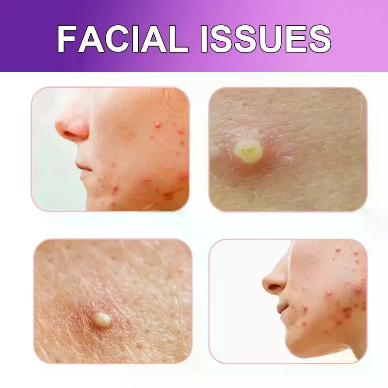 JAYSUING Colorful Acne Patch Cover Pimple Scar Shrink Pores Repair Balance Facial Skin Waterproof Breathable Spot Stickers