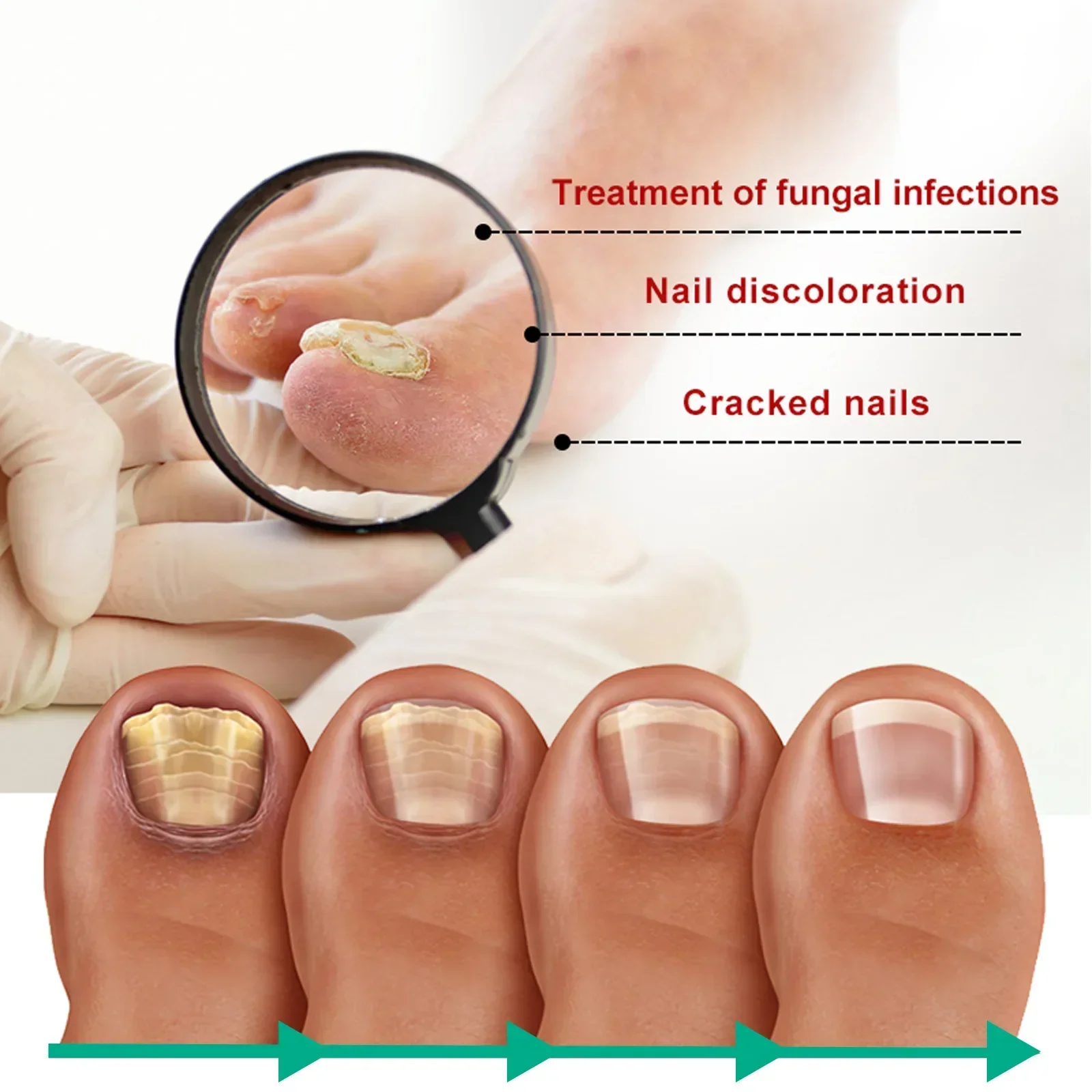 Aceite Esencial para tratamiento de hongos en las uñas, suero para la eliminación de hongos en los pies, 7 días de reparación, onicomicosi, Gel antiinfección, productos para el cuidado