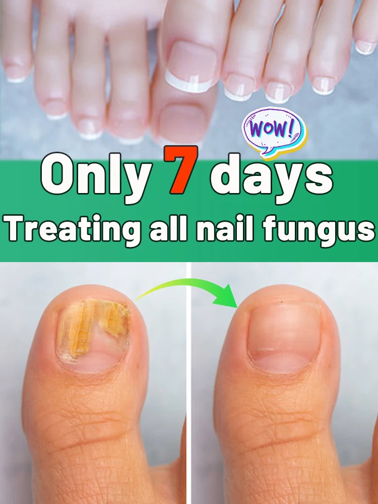 

ᔆᵗᵘᵇᵇᵒʳⁿ ᵒⁿʸᶜʰᵒᵐʸᶜᵒˢⁱˢ ʳᵉᵖᵃⁱʳ ᵉˢˢᵉⁿᵗⁱᵃˡ ᵒⁱˡ⸴ ˡᵉᵗ ʸᵒᵘ ᵍᵉᵗ ʳⁱᵈ ᵒᶠ ⁿᵃⁱˡ ᶠᵘⁿᵍᵘˢ