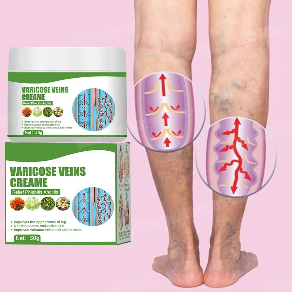 Varicose Vein Treatment Cream 20g Painless Removal Spider Vein Pain Varicosity Effective Varicose Healing Cream