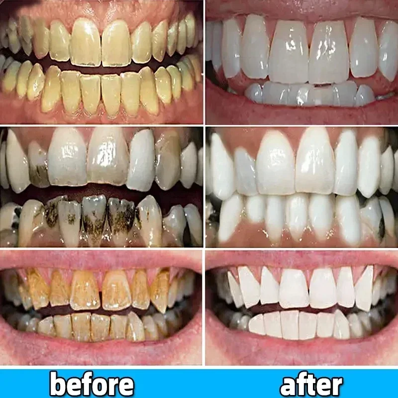 Dissolvant de calcul dentaire, blanchiment des dents, dentifrice, éclaircissant, prévention de la parodontite, élimination de la mauvaise haleine,