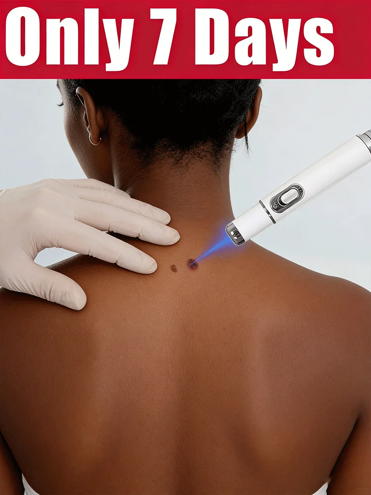 2026 3rd-Generation Laser Wart Remover – 7 Days to Eradicate All Warts