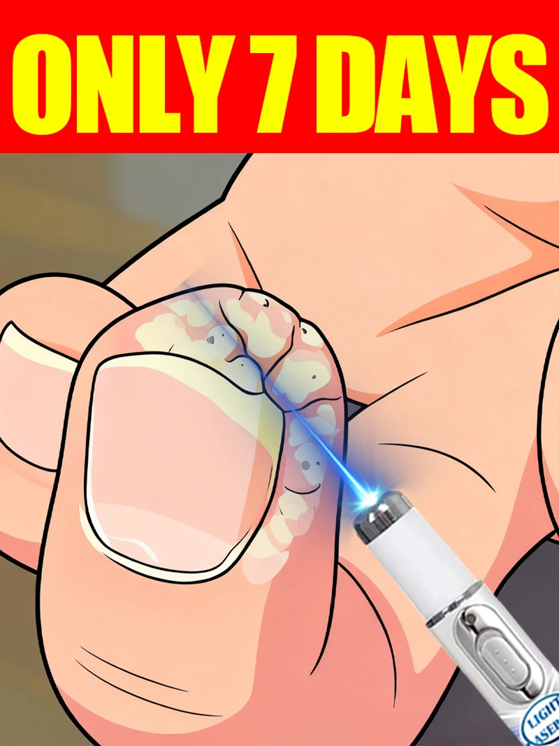 

Generation-3 Laser Says Goodbye To all warts In 7 Days