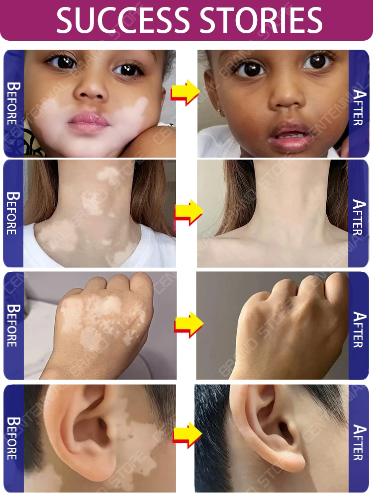 Vitiligo creme, 7 dias rápido, eliminar mancha branca e melhorar a pele