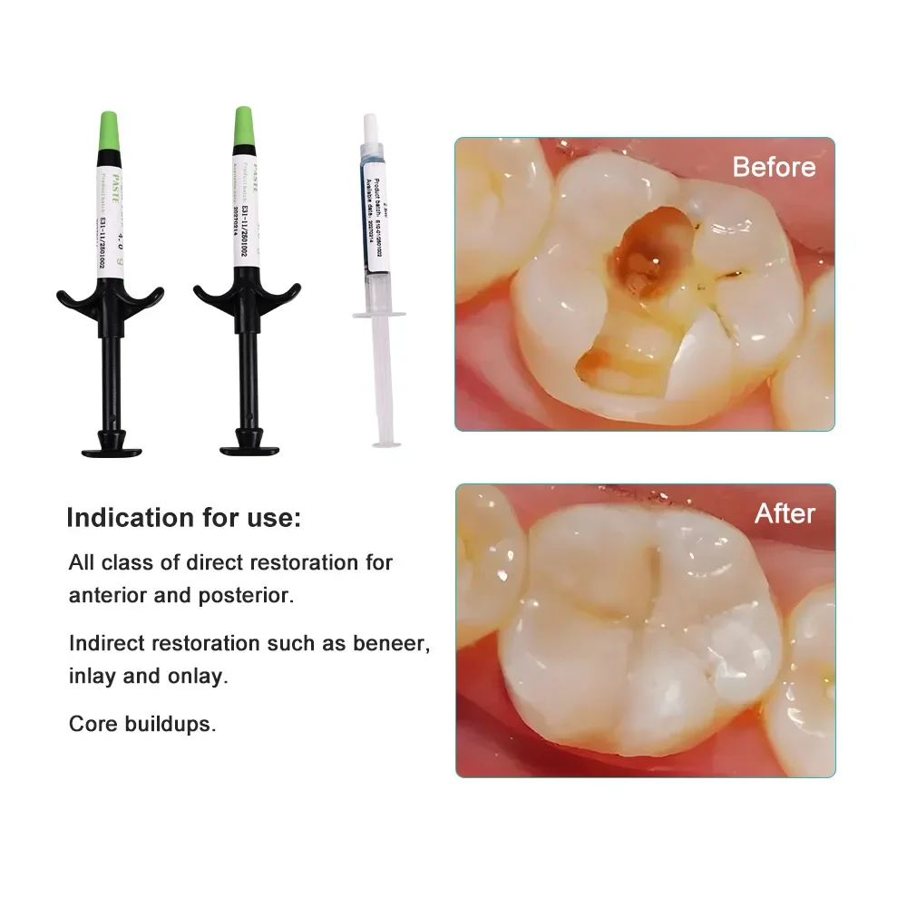 دعامة الأسنان الأخضر الغراء المواد اللاصقة تقويم الأسنان العالمي علاج الضوء لقوس أنبوب السندات لصق محفور حمض هلام طبيب الأسنان المواد