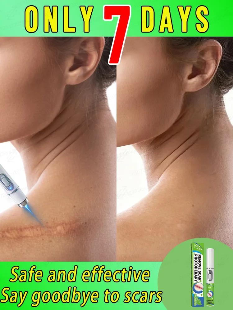 

Домашняя лазерная указка, супер эффективная для уменьшения пигментации плоских выпуклых шрамов.