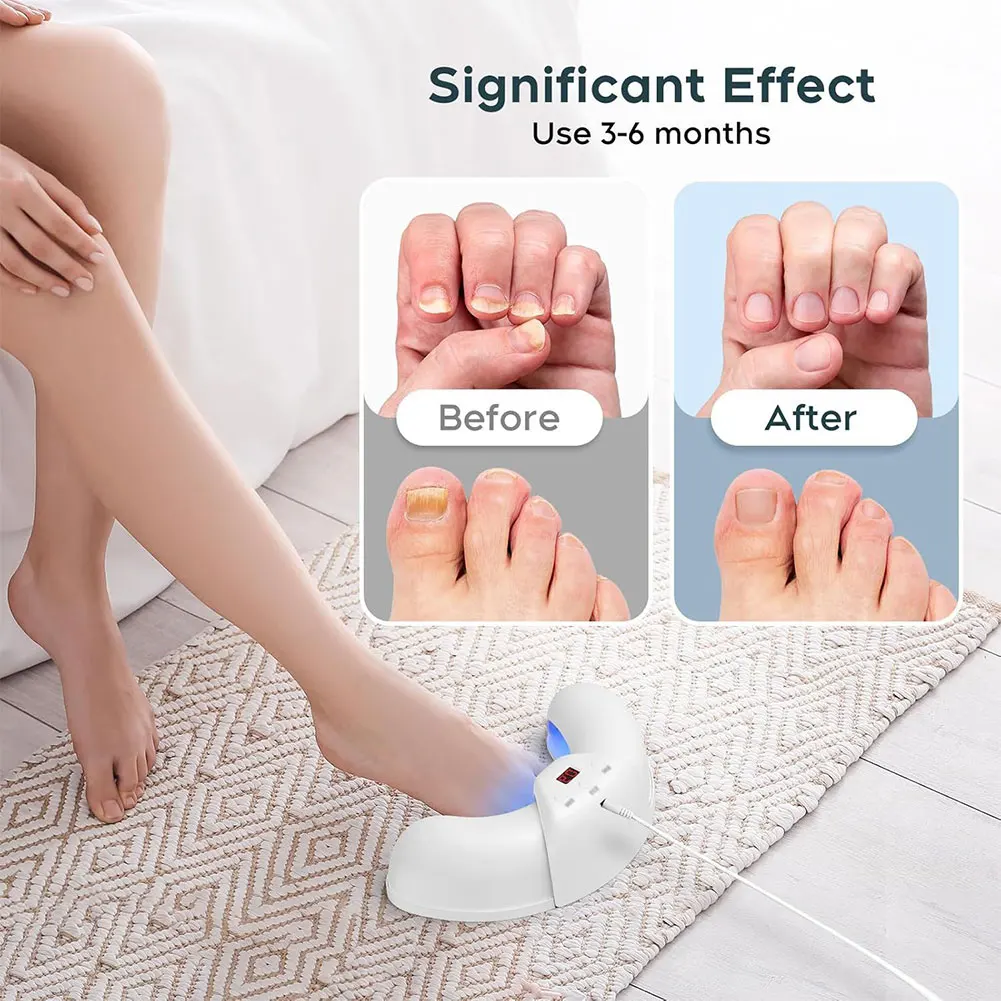 Dispositif Laser LED pour le traitement des champignons des ongles, pour le nettoyage de l'onychomycose, Charge USB 45W 470nm, lumière bleue pour les ongles décolorés et épaississent