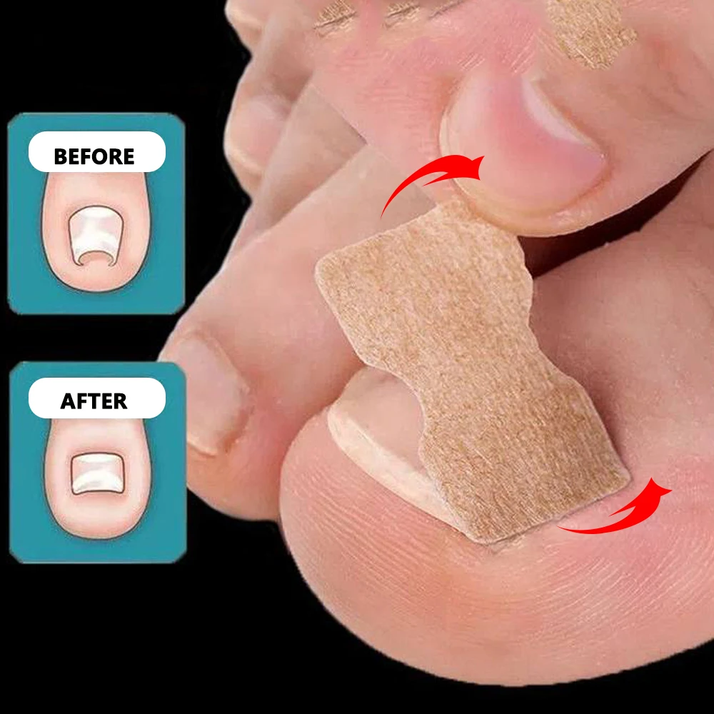 100PCS Toenail Correction Stickers Breathable Ingrown Toenail Corrector Patches Treatment Recover Corrector Pedicure Care Tools