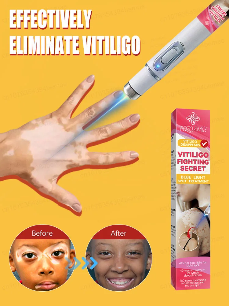 Nationally certified vitiligo white spot cure laser