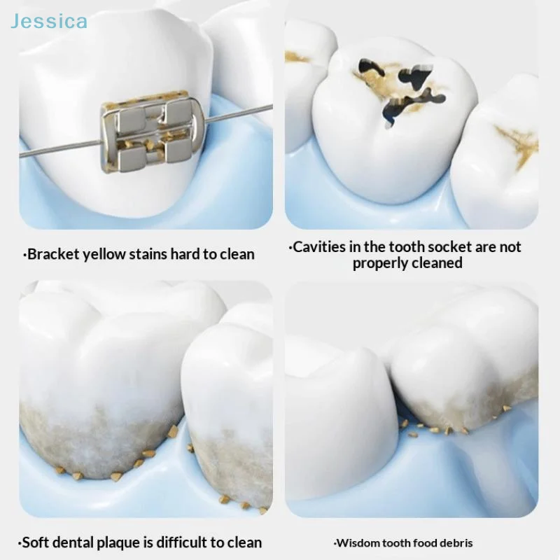 ♥ فرشاة تقويم الأسنان بين الأسنان - أداة تنظيف عميق بشعيرات متناهية الصغر للأقواس والأقواس والشورات واللثة (مقبض مريح) #4