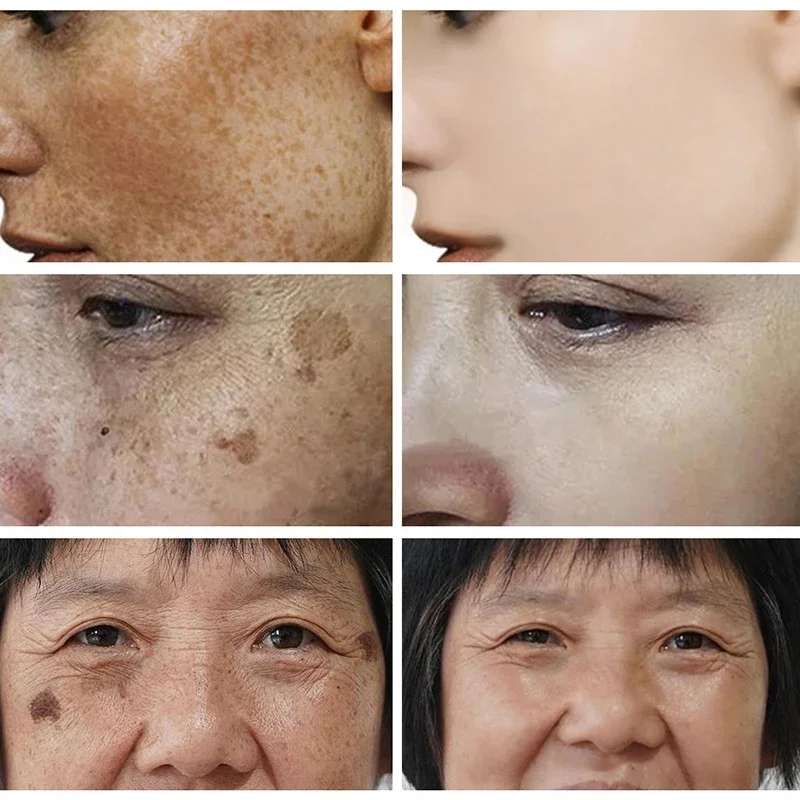 Gezichtsverhelderende Crème Niacinamide Verminderen Chloasma Melasma Melanine Vervagen Fijne Lijntjes Verlichten Donkere Huid Serumverzorging Fleuren Crème