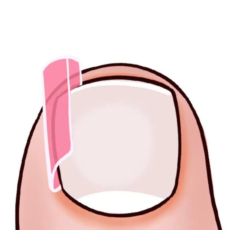 50Pcs Ingrown Toe Nail Treatment Elastic Patch Sticker Straightening Clip Brace Pedicure Tool Ingrown Toenail Correction Tool