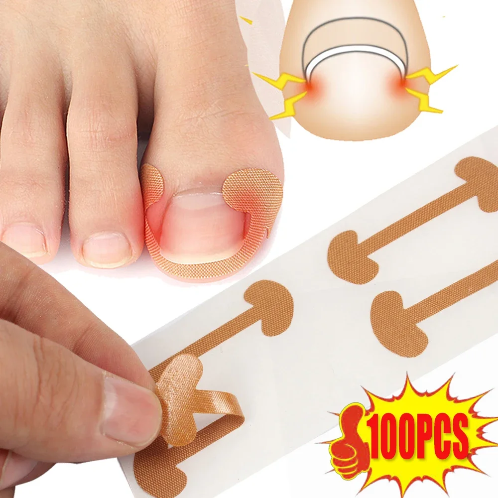20–100 Stück Korrekturstreifen für eingewachsene Zehennägel, dauerhafte Haftung, wasserfeste Nagelkorrektur-Aufkleber, Elastizität, Zehenpflege, Pediküre – Detail 1
