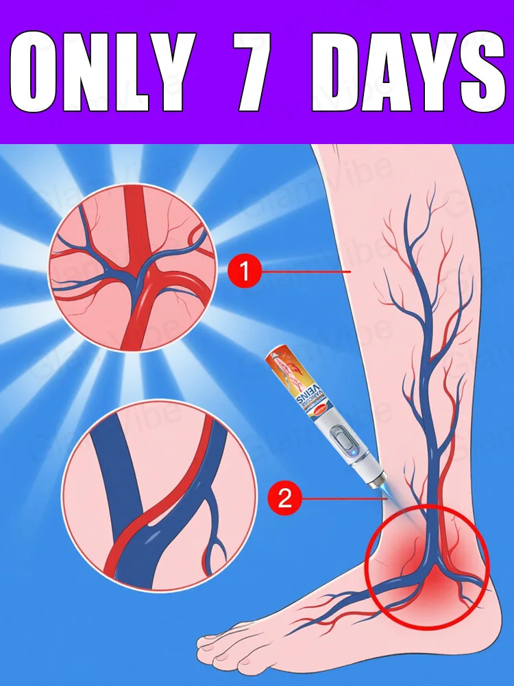 

Generation-2 Laser Says Goodbye To Spider Legs Varicose In 7 Days