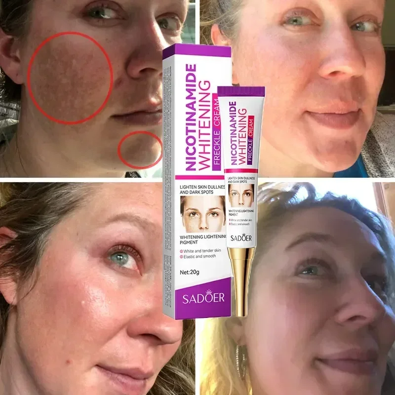 Niacinamide Whitening Freckle Cream Effectively Lightens Black Spots Acne Marks Removes Melasma Brightens Healthy Skin Mild