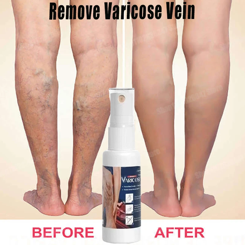 

Effective Varicose Vein Spray Natural Herb Veins Soothing Essential Spray Vasculitis Phlebitis Spider Vein Earthworm Leg Cure