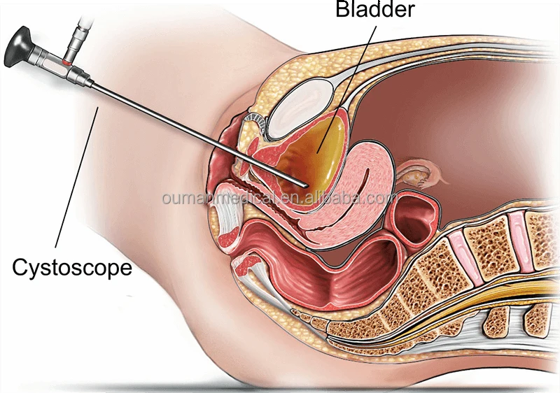 

Endoscopy Recording Device Cystoscope HD Rigid Surgical 4mm 0 30 70 degree cystoscopy Endoscope