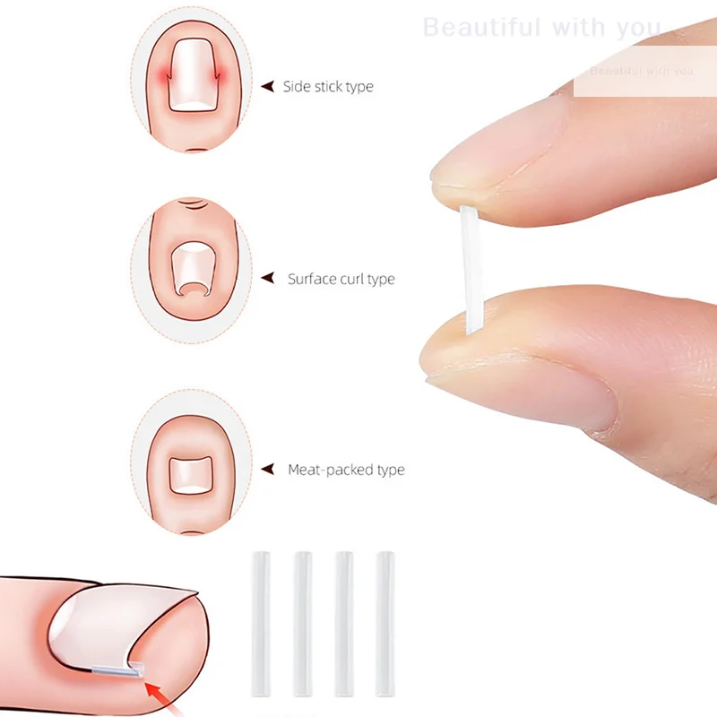 10 peças clipe de alisamento de unha encravada correção de unha adesivo adesivo