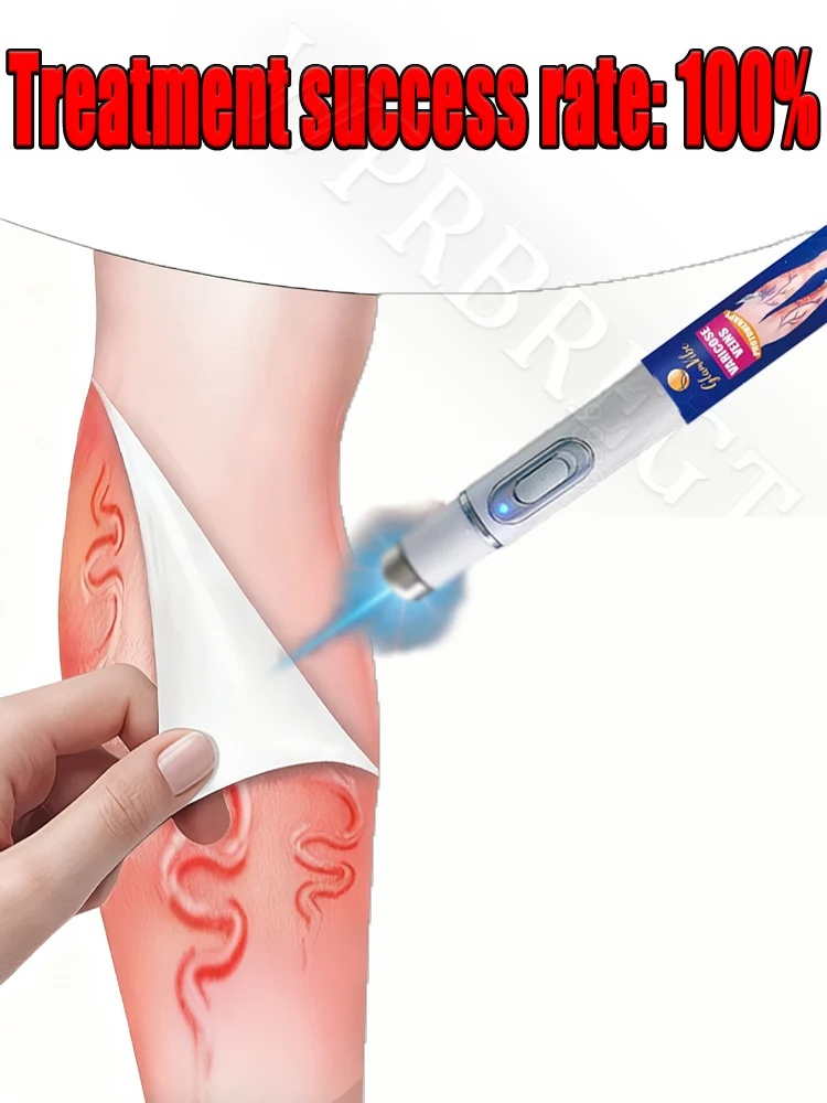 

Лазерное лечение устраняет боль в виде паука ног, снимает васкулит и флебит, а также сопровождается лечения лазерной указки.