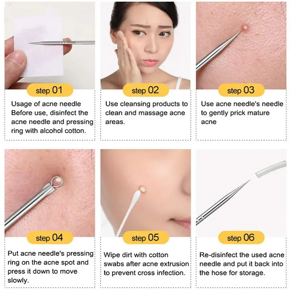4 STKS Mee-eter Verwijderen Naalden Zwarte Stippen Cleaner Roestvrij staal Spot Extractor Acne Behandeling Naald Set Gezicht Schoon Care Tool
