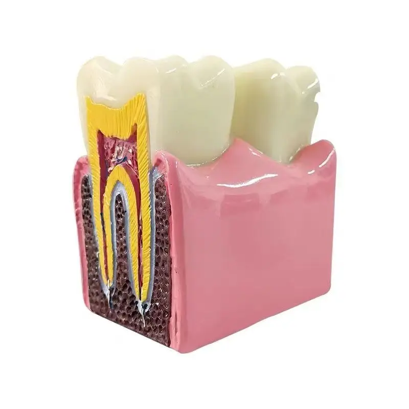 Patient communication monomer Dissection enlarge model 6X Caries Compare Models free shipping