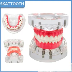 Dental Implant Model Upper/Lower Dental Removable Implant Model with 4 Implants Screws Dental Teaching Demo Model