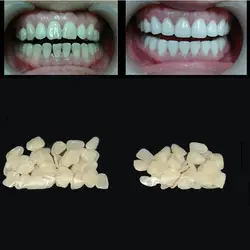 Carillas dentales ultrafinas de porcelana para la parte superior delantera, dientes de resina, belleza médica, 70 unids/lote por paquete