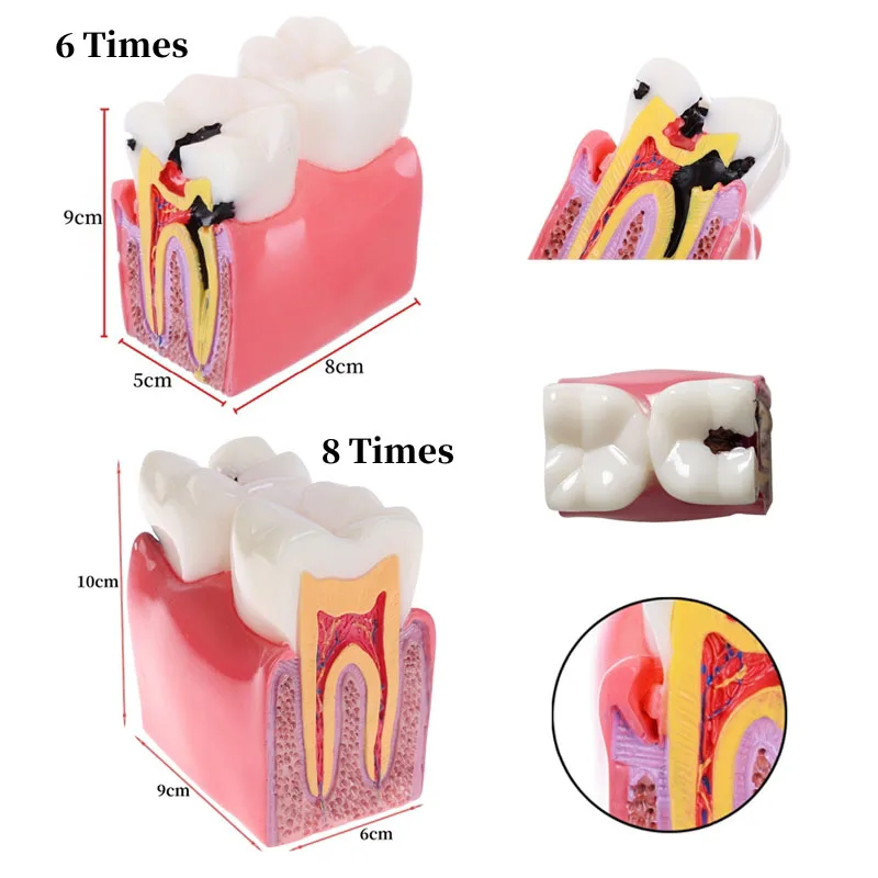 Model zębów stomatologiczne 6/8 razy badanie próchnicy Model protezy anatomia Model nauczania Model demonstracyjny dentysta