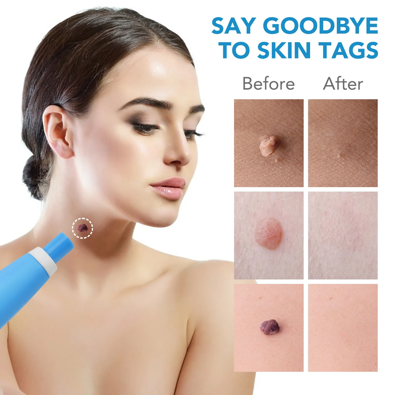 2 In 1 Automatic Skin Tag Remover Kit Miniature Skin Tag Remover Adult Mole Stains Wart Remover Facial Care Beauty Tool