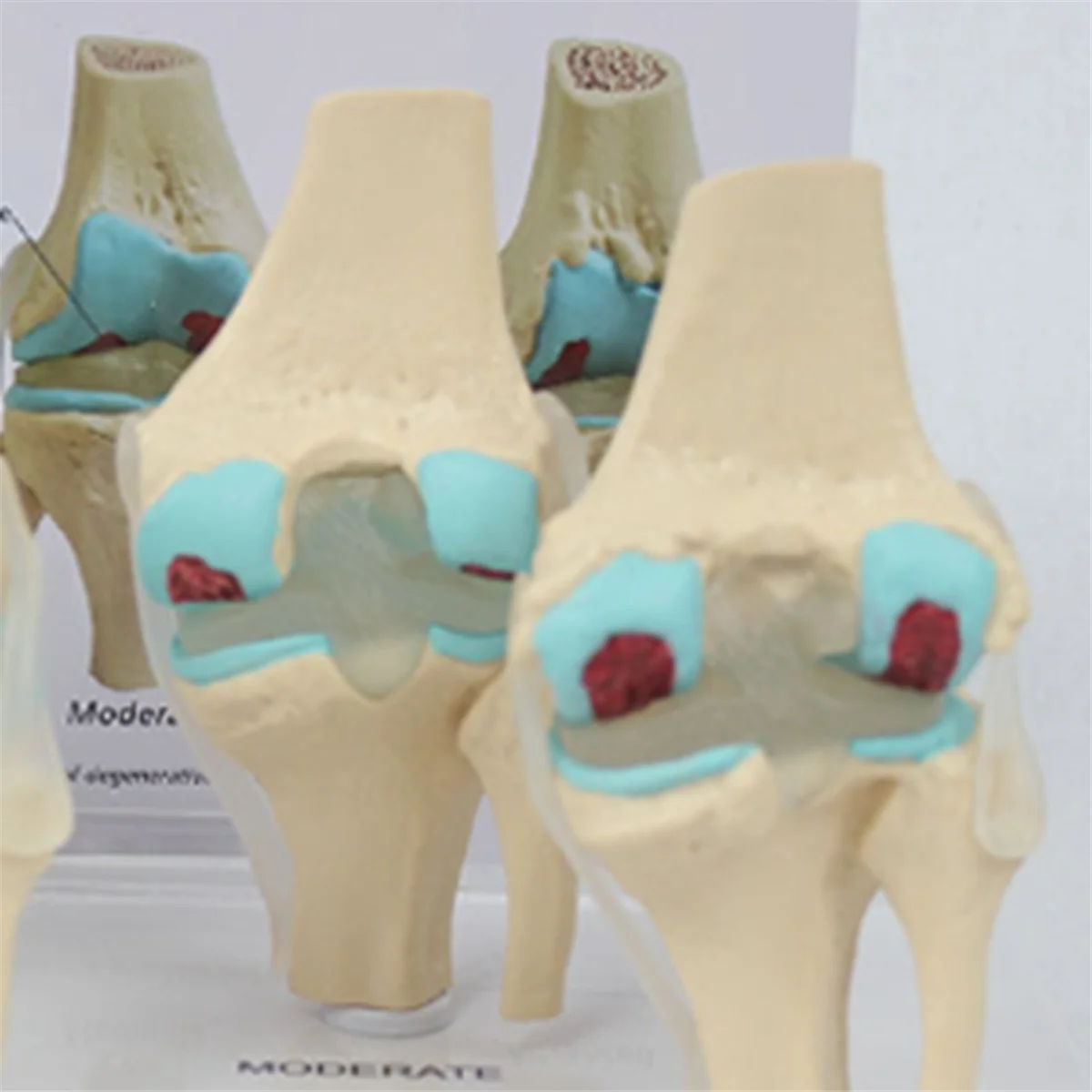 Zestaw do kolan choroba zwyrodnieniowa stawów Model anatomiczny z karta klucz edukacyjnym 4-stopniowy Model kolana pomoce nauczycielskie ortopedyczny